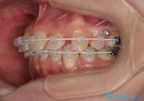 出っ歯と深い噛み合わせ:抜歯矯正で口元スッキリ!の治療中