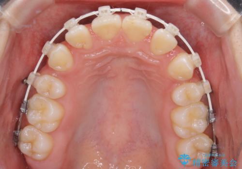 出っ歯と深い噛み合わせ:抜歯矯正で口元スッキリ!の治療中