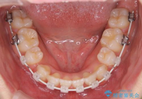 出っ歯と深い噛み合わせ:抜歯矯正で口元スッキリ!の治療中