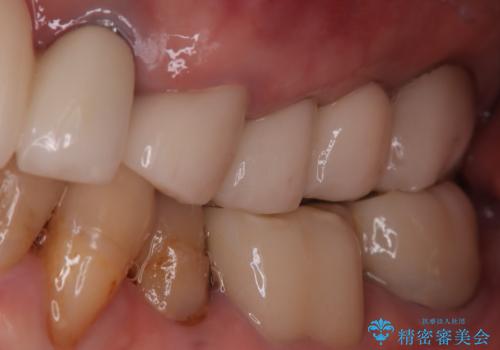 【抜歯即時埋入即時過重】1DAYインプラントの症例 治療前