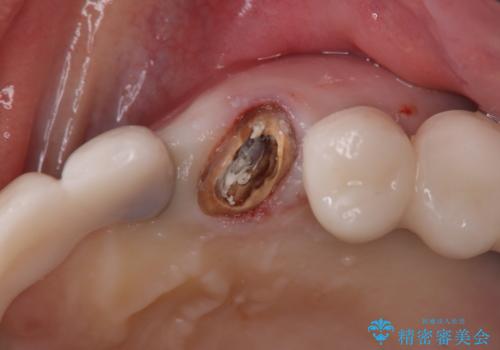 【抜歯即時埋入即時過重】1DAYインプラントの治療前