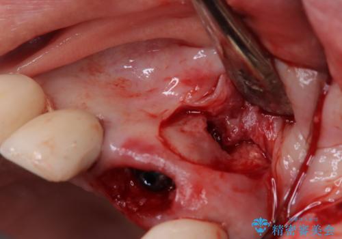 【抜歯即時埋入即時過重】1DAYインプラントの治療中