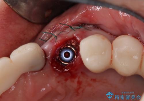 【抜歯即時埋入即時過重】1DAYインプラントの治療中