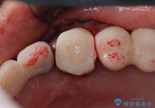 【抜歯即時埋入即時過重】1DAYインプラントの治療中