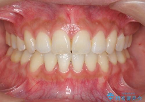 ガタつきと口元の改善　抜歯を伴うワイヤー矯正の症例 治療後