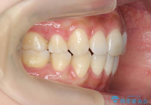 ガタつきと口元の改善　抜歯を伴うワイヤー矯正の治療後
