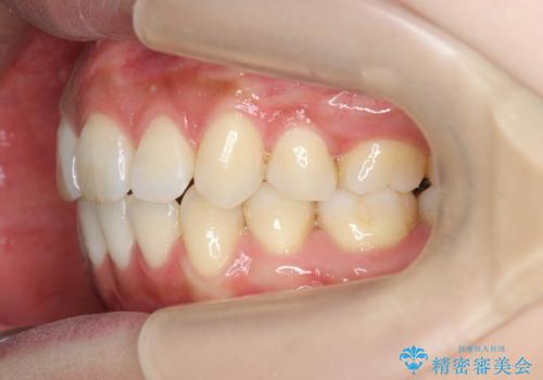 ガタつきと口元の改善　抜歯を伴うワイヤー矯正の治療後
