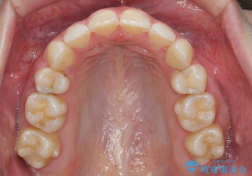 ガタつきと口元の改善 抜歯を伴うワイヤー矯正の治療後