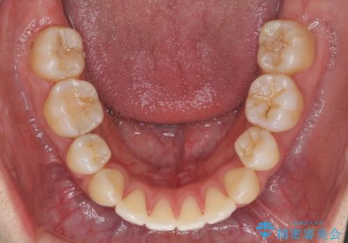 ガタつきと口元の改善 抜歯を伴うワイヤー矯正の治療後