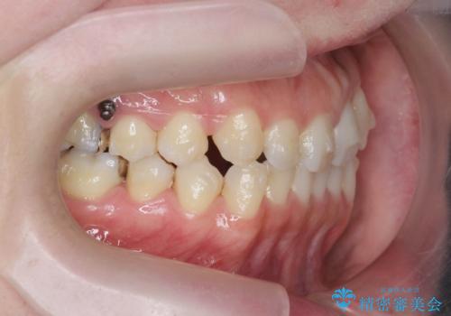 [ 引っ込んだ前歯を治したい ] 歯を抜かないマウスピース矯正の治療前