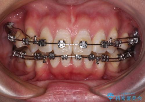 上顎前突で口が閉じにくい　ワイヤー装置での抜歯矯正の治療中