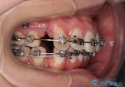 上顎前突で口が閉じにくい　ワイヤー装置での抜歯矯正の治療中