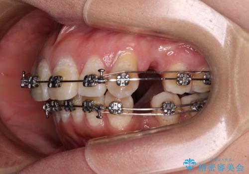 上顎前突で口が閉じにくい ワイヤー装置での抜歯矯正の治療中