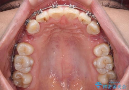 上顎前突で口が閉じにくい ワイヤー装置での抜歯矯正の治療中