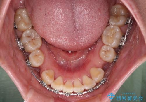 上顎前突で口が閉じにくい ワイヤー装置での抜歯矯正の治療中