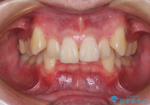 八重歯の抜歯矯正　インビザラインを用いて気になる歯並びを改善の症例 治療前