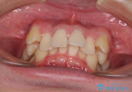 八重歯の抜歯矯正 インビザラインを用いて気になる歯並びを改善の治療前