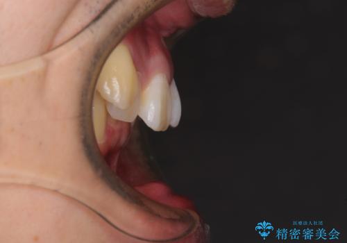 八重歯の抜歯矯正　インビザラインを用いて気になる歯並びを改善の治療前