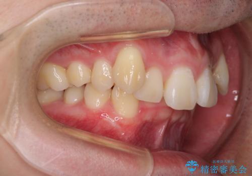 八重歯の抜歯矯正 インビザラインを用いて気になる歯並びを改善の治療前