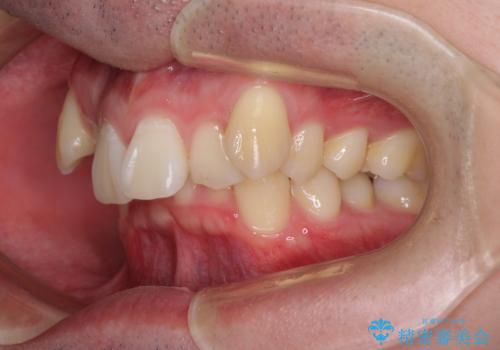 八重歯の抜歯矯正 インビザラインを用いて気になる歯並びを改善の治療前