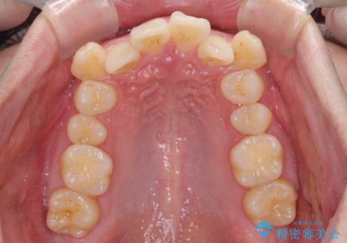 八重歯の抜歯矯正 インビザラインを用いて気になる歯並びを改善の治療前