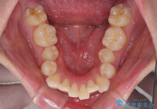 八重歯の抜歯矯正 インビザラインを用いて気になる歯並びを改善の治療前