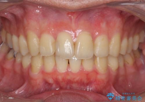 出っ歯と歯のねじれ　非抜歯で　30代男性の症例 治療後