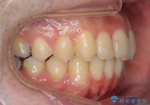 出っ歯と歯のねじれ　非抜歯で　30代男性の治療後