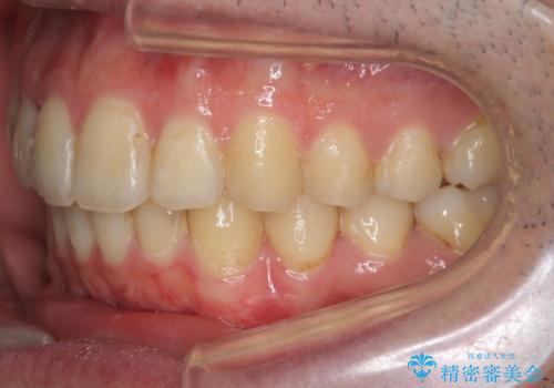 出っ歯と歯のねじれ 非抜歯で 30代男性の治療後
