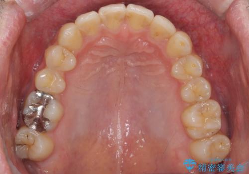 出っ歯と歯のねじれ 非抜歯で 30代男性の治療後
