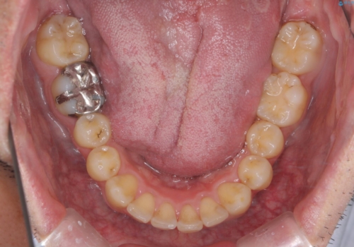 出っ歯と歯のねじれ　非抜歯で　30代男性の治療後