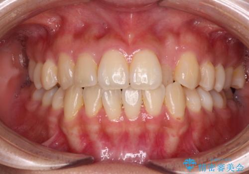 クロスバイトの前歯を改善　ワイヤー装置で楽々矯正治療の症例 治療前
