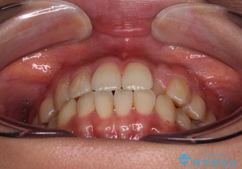 クロスバイトの前歯を改善 ワイヤー装置で楽々矯正治療の治療前
