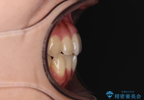 クロスバイトの前歯を改善　ワイヤー装置で楽々矯正治療の治療前