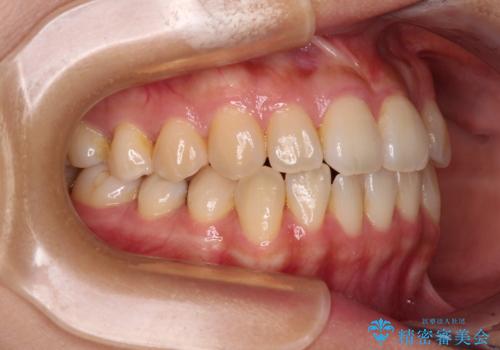 クロスバイトの前歯を改善 ワイヤー装置で楽々矯正治療の治療前