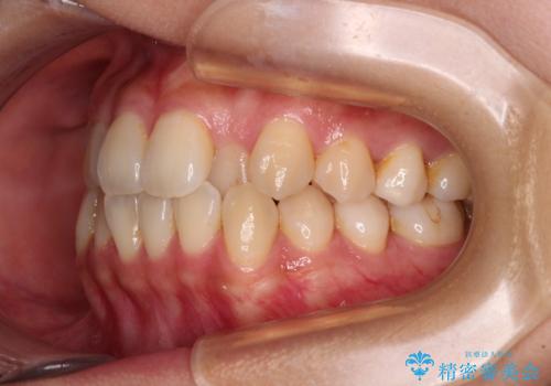 クロスバイトの前歯を改善 ワイヤー装置で楽々矯正治療の治療前