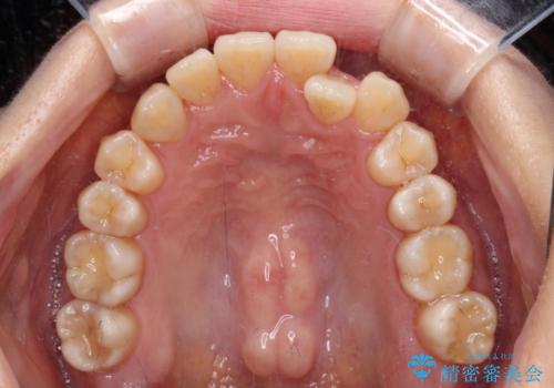 クロスバイトの前歯を改善 ワイヤー装置で楽々矯正治療の治療前