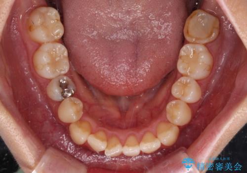 クロスバイトの前歯を改善 ワイヤー装置で楽々矯正治療の治療前