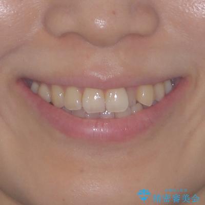 クロスバイトの前歯を改善 ワイヤー装置で楽々矯正治療の治療前(顔貌)