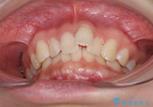 前歯のデコボコを治したい インビザライン矯正治療の治療前