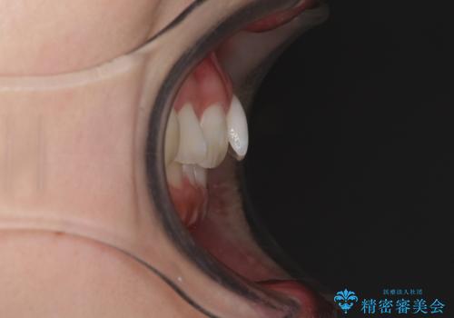 前歯のデコボコを治したい インビザライン矯正治療の治療前