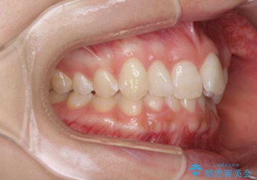 前歯のデコボコを治したい インビザライン矯正治療の治療前