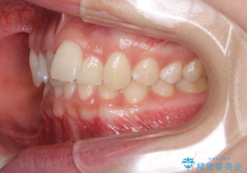 前歯のデコボコを治したい インビザライン矯正治療の治療前