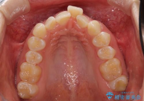 前歯のデコボコを治したい インビザライン矯正治療の治療前