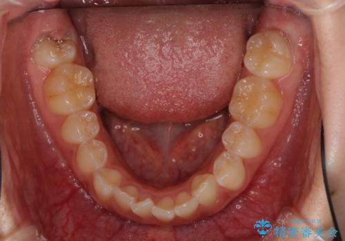 前歯のデコボコを治したい インビザライン矯正治療の治療前