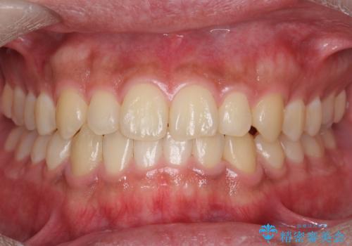 骨格性の受け口　非抜歯で下の歯を後ろに下げる　インビザラインで　インプラント矯正の治療後