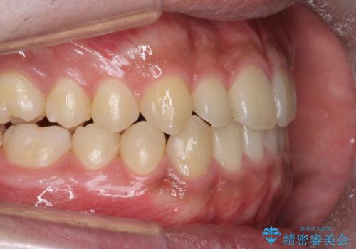 骨格性の受け口 非抜歯で下の歯を後ろに下げる インビザラインで インプラント矯正の治療後