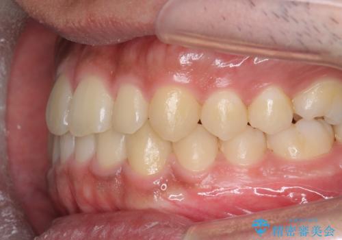 骨格性の受け口 非抜歯で下の歯を後ろに下げる インビザラインで インプラント矯正の治療後