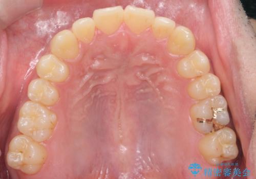 骨格性の受け口　非抜歯で下の歯を後ろに下げる　インビザラインで　インプラント矯正の治療後