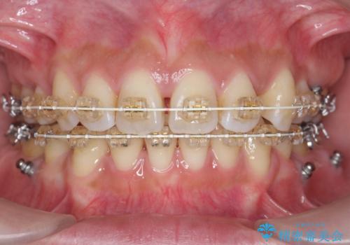 ガタつきと口元の改善 抜歯を伴うワイヤー矯正の治療中